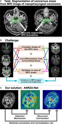 AttR2U-Net: A Fully Automated Model for MRI Nasopharyngeal Carcinoma Segmentation Based on Spatial Attention and Residual Recurrent Convolution